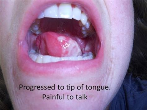 Rinse your mouth 4 to 6 times a day, especially after meals, with water, salt and baking soda. . Tongue recovery after radiation
